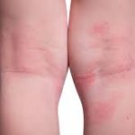 psoriaza alebo ekzem